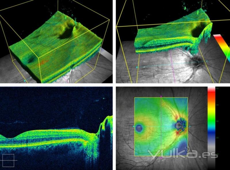 OCT  de papila _3D