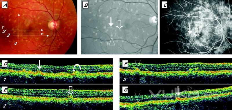 al detalle y sin biopsia