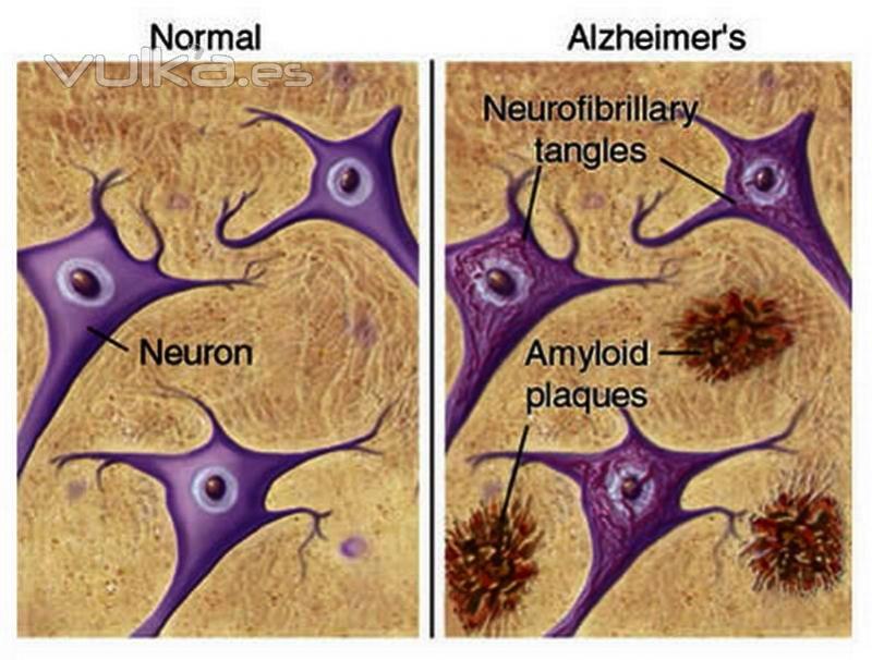 depositos amiloide ( versus DMAE-Alzheimer) ?