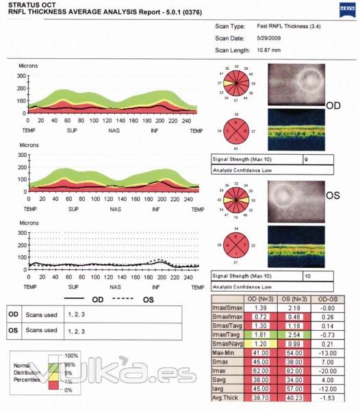 glaucoma, deteccion precoz  Como tienes la CFN?  revision, por favor