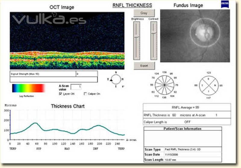 tener un tomografo, es una ventaja en el glaucoma