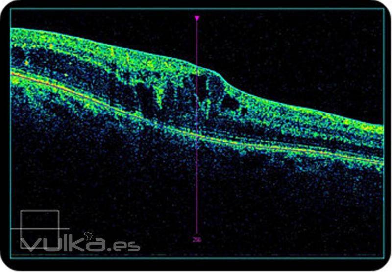 edema -atrofia -quistes en fovea