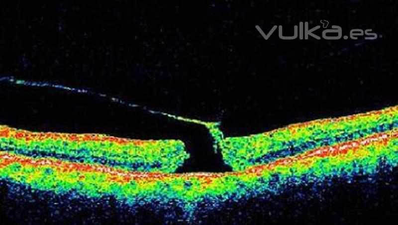 formacion de agujero macular