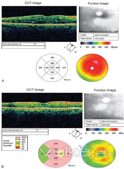 edema en macula