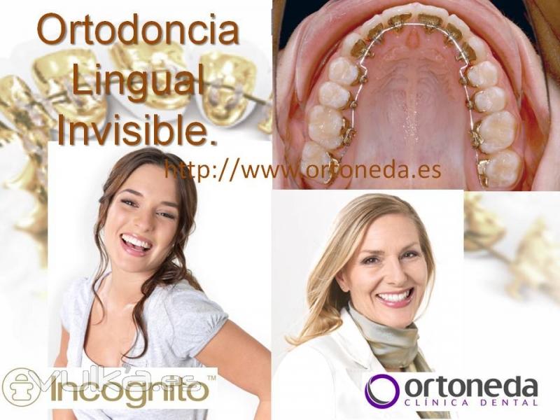 Ortodoncia Lingual. Incognito