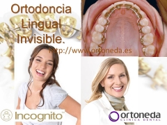 Ortodoncia lingual incognito