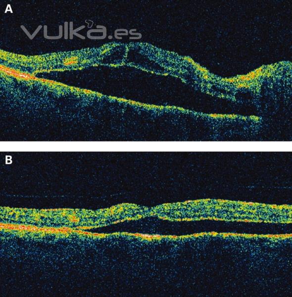 desprendimiento seroso bilateral