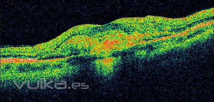 degeneracion macular