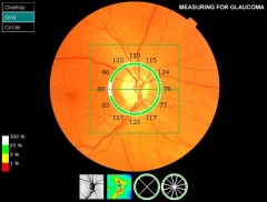 Medicion del espesor de fibras hoy es diagnostico de certeza