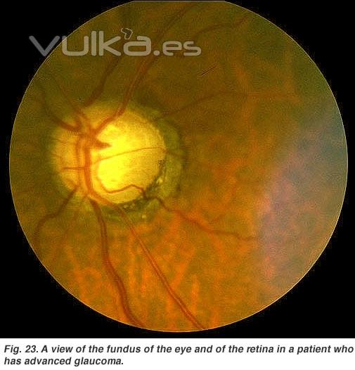 glaucoma avanzado. 65 % ceguera legal