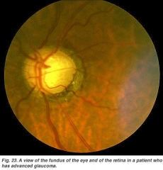 Glaucoma avanzado. 65 % ceguera legal
