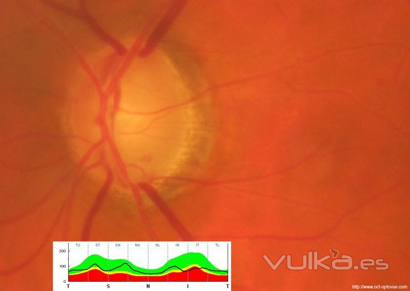 Glaucoma incipiente. Hazte una OCT