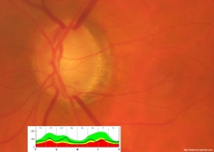 Glaucoma incipiente hazte una oct