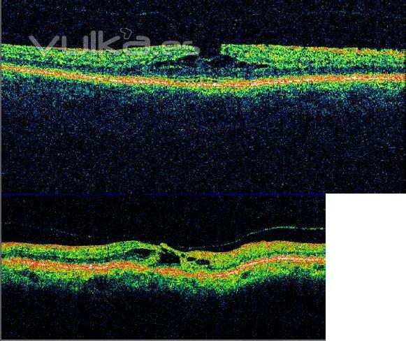 agujero macular en estadio 2