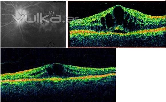 adema macular yatrogeno