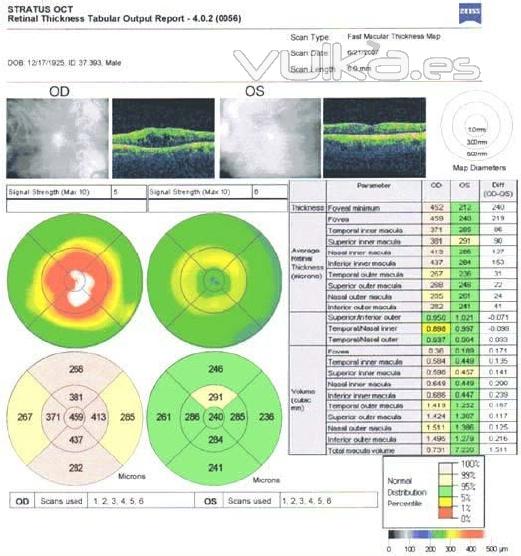 edema macular post faco