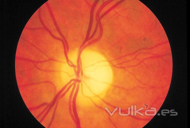 atrofia optica, vascular !