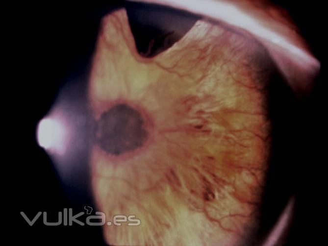 glaucoma neovascular terminal
