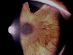Glaucoma neovascular terminal