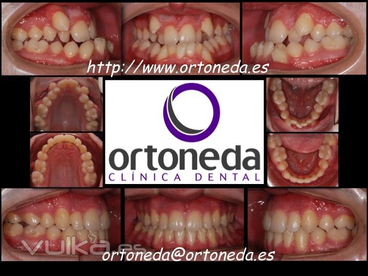 Ortodoncia Adultos. Clase III esqueltica