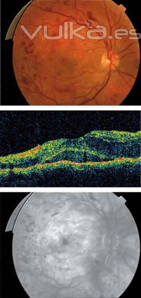 edema diabetico