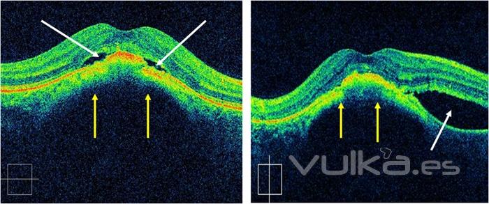 liquido intraretiniano