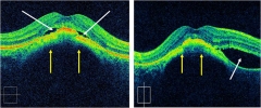 Liquido intraretiniano