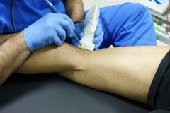 Epi en tendn de biceps femoral