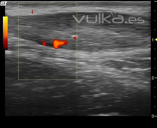 Tendinosis de aquiles con neovascularizacin