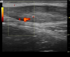 Tendinosis de aquiles con neovascularizacion
