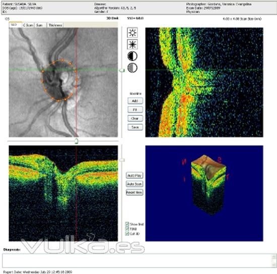 glaucoma, s o no