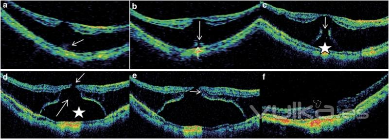 de retinosquisis a agujero: 2 meses