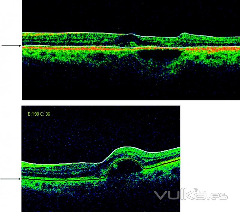 degeneracion macular con DEP