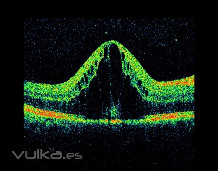 edema macular diabetico