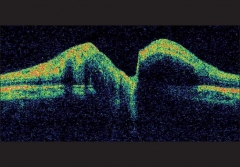 Infiltracion papilar en leucemia