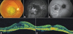 Nevus coroideo