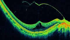 Traccion vitrea