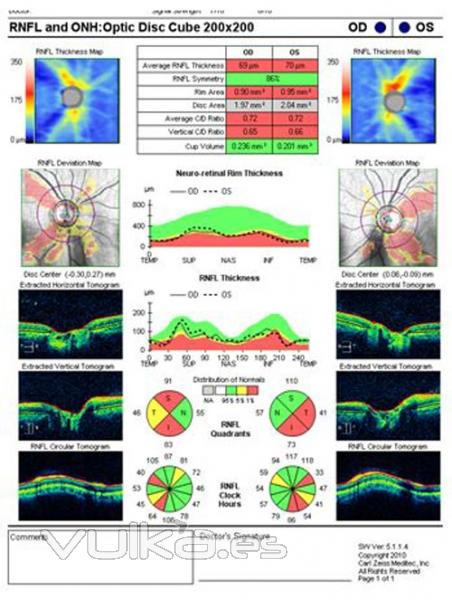 glaucoma en los lmites