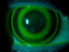 Adaptación de lentes de Terapia Nocturna