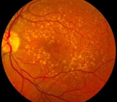 Dmae seca: oct foveal normal