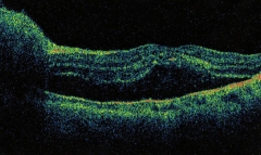 Oct de bartelonosis