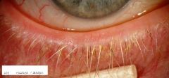 Rosacea y blefaritis staphilococica