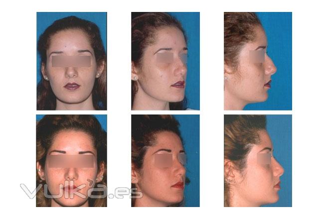 rinoplastia, mentoplastia, blefaroplastia, aumento de labios, rejuvenecimiento facial, ciruga ortog