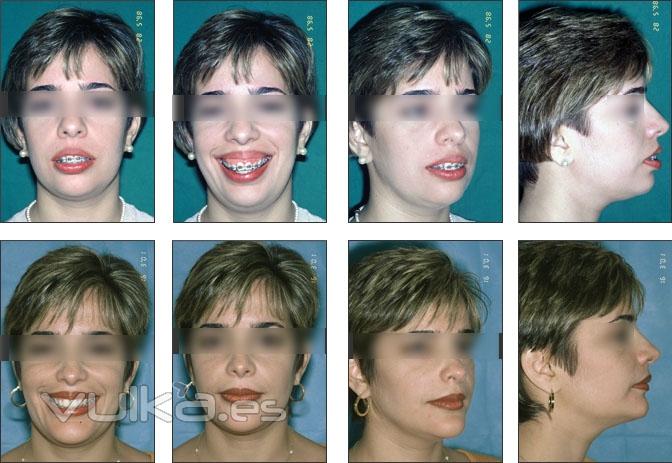 rinoplastia, mentoplastia, blefaroplastia, aumento de labios, rejuvenecimiento facial, ciruga ortog