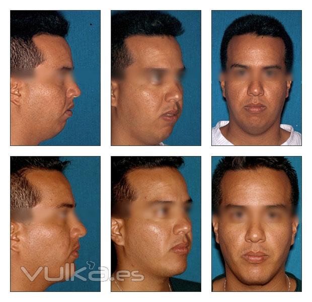 rinoplastia, mentoplastia, blefaroplastia, aumento de labios, rejuvenecimiento facial, ciruga ortog