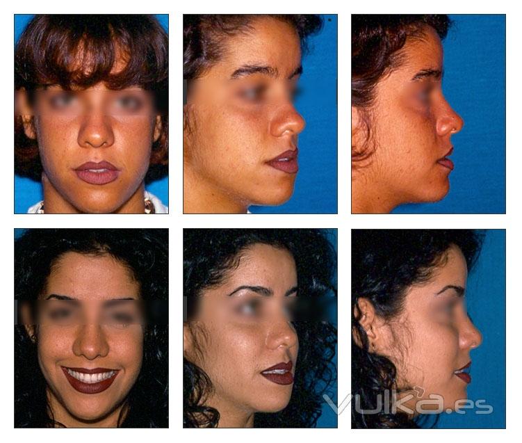 rinoplastia, mentoplastia, blefaroplastia, aumento de labios, rejuvenecimiento facial, ciruga ortog