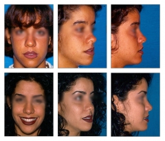 Rinoplastia, mentoplastia, blefaroplastia, aumento de labios, rejuvenecimiento facial, ciruga ortog
