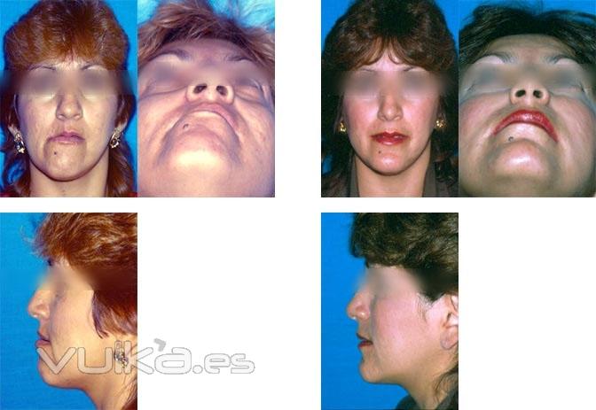 rinoplastia, mentoplastia, blefaroplastia, aumento de labios, rejuvenecimiento facial, ciruga ortog
