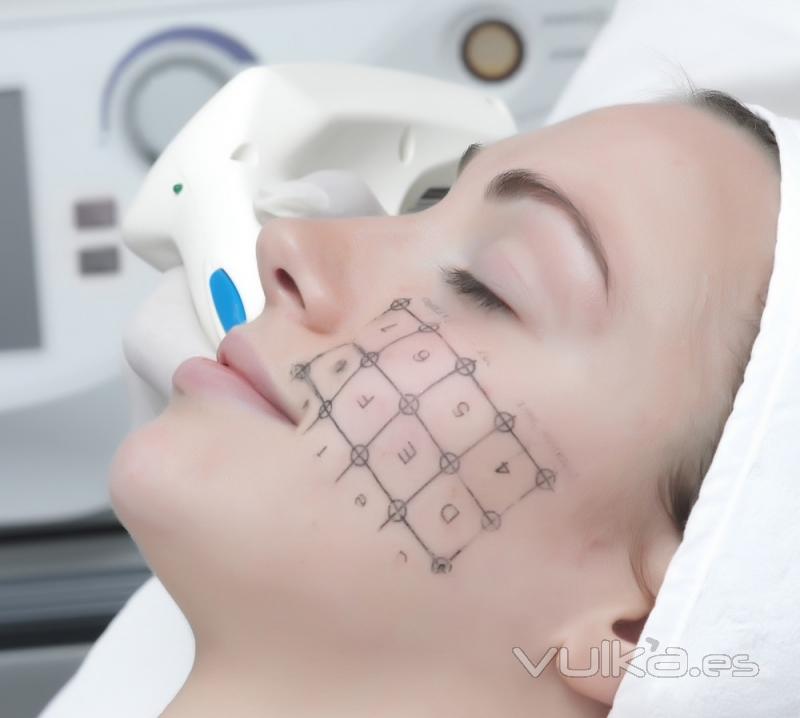 Radiofrecuencia facial