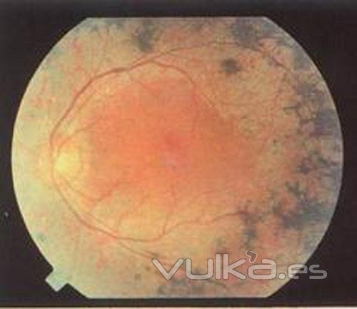 retinitis y AO 